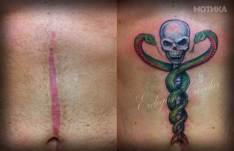 emgn-scar-tattoo-9